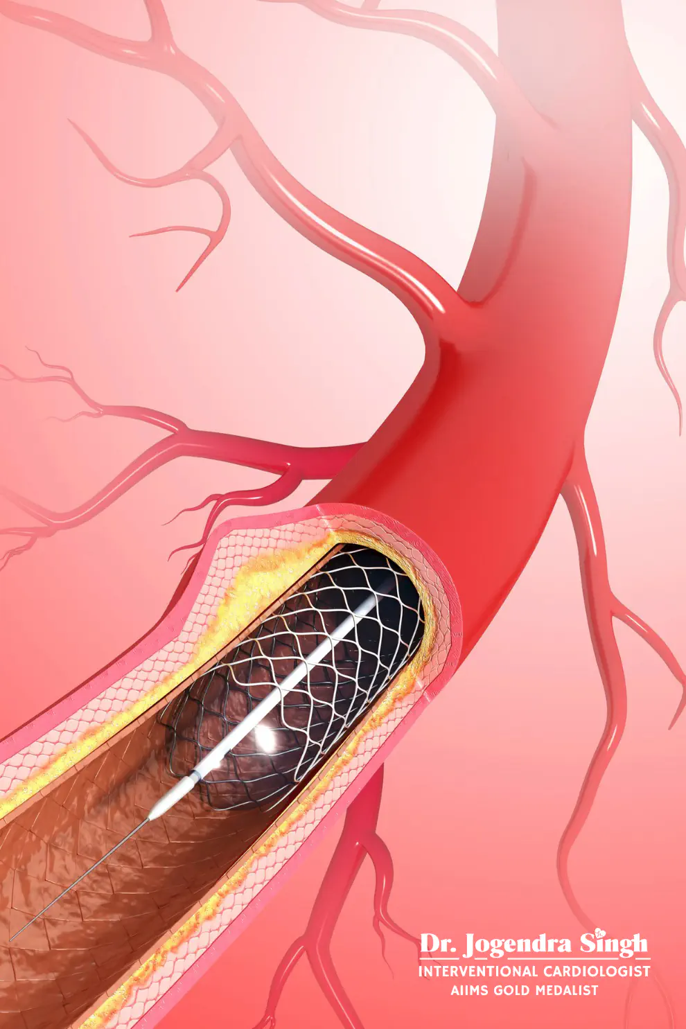 CORONARY INTERVENTIONS - Dr. Jogendra Singh