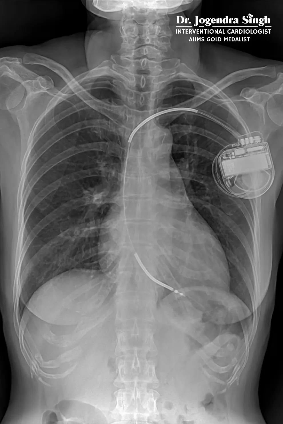 Combo Device Implantation- Dr. Jogendra Singh