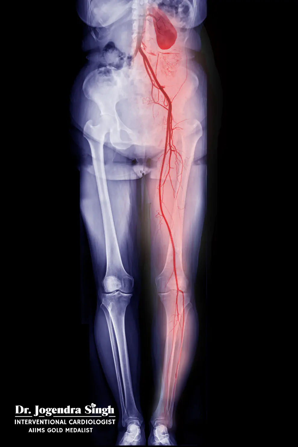 PERIPHERAL & NON-CORONARY INTERVENTIONS - Dr. Jogendra Singh